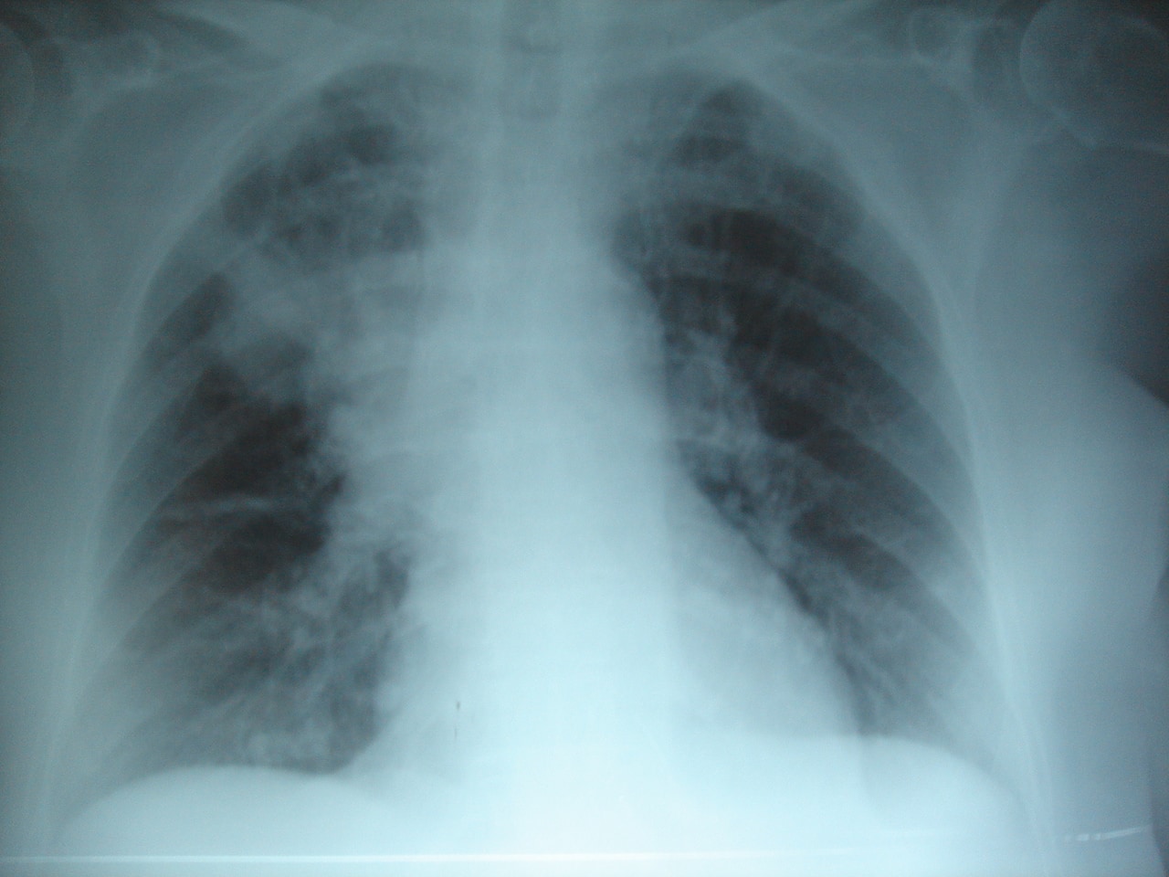 Cómo diagnosticar la infección pulmonar o neumonía asociada a la ventilación (NAV)