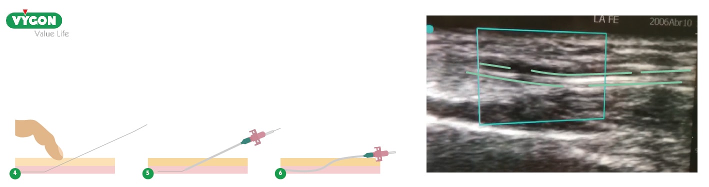  Verificar la correcta posición del catéter en el interior de la arteria radial 