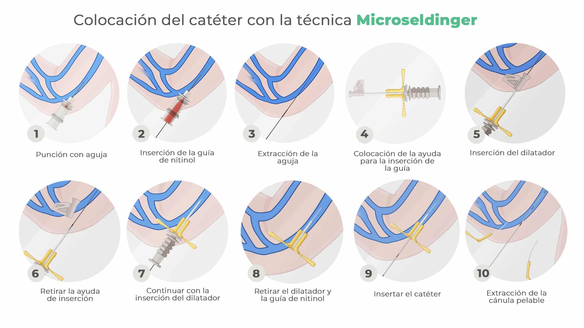 Colocación microseldinger