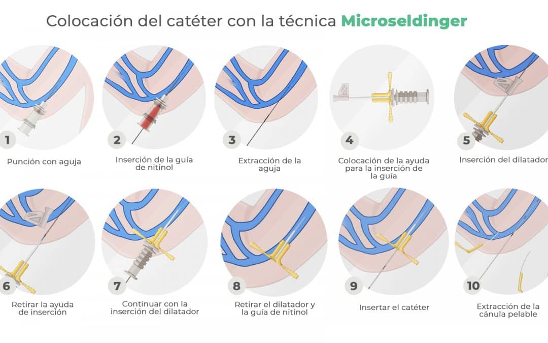 Técnica Microseldinger o Seldinger modificada: colocación de PICC