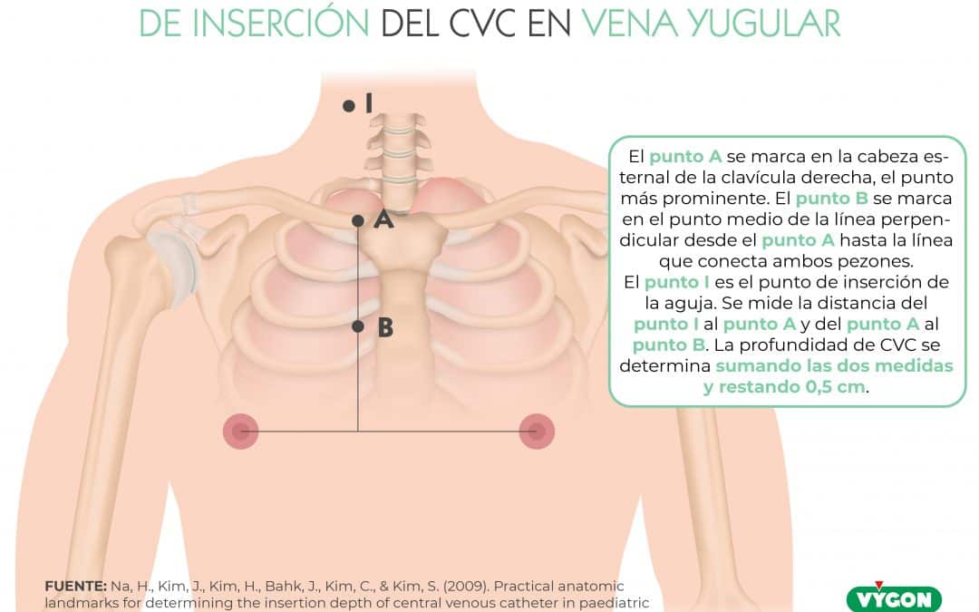 Método para determinar la profundidad de inserción del CVC en vena yugular