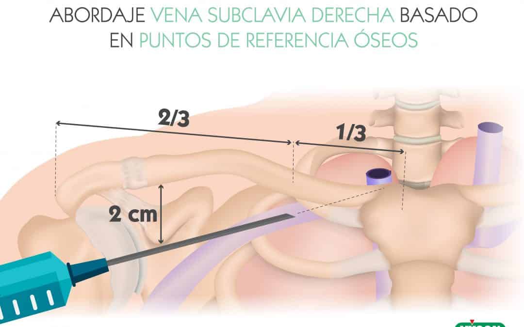 Abordaje vena subclavia derecha basado en puntos de referencia óseos